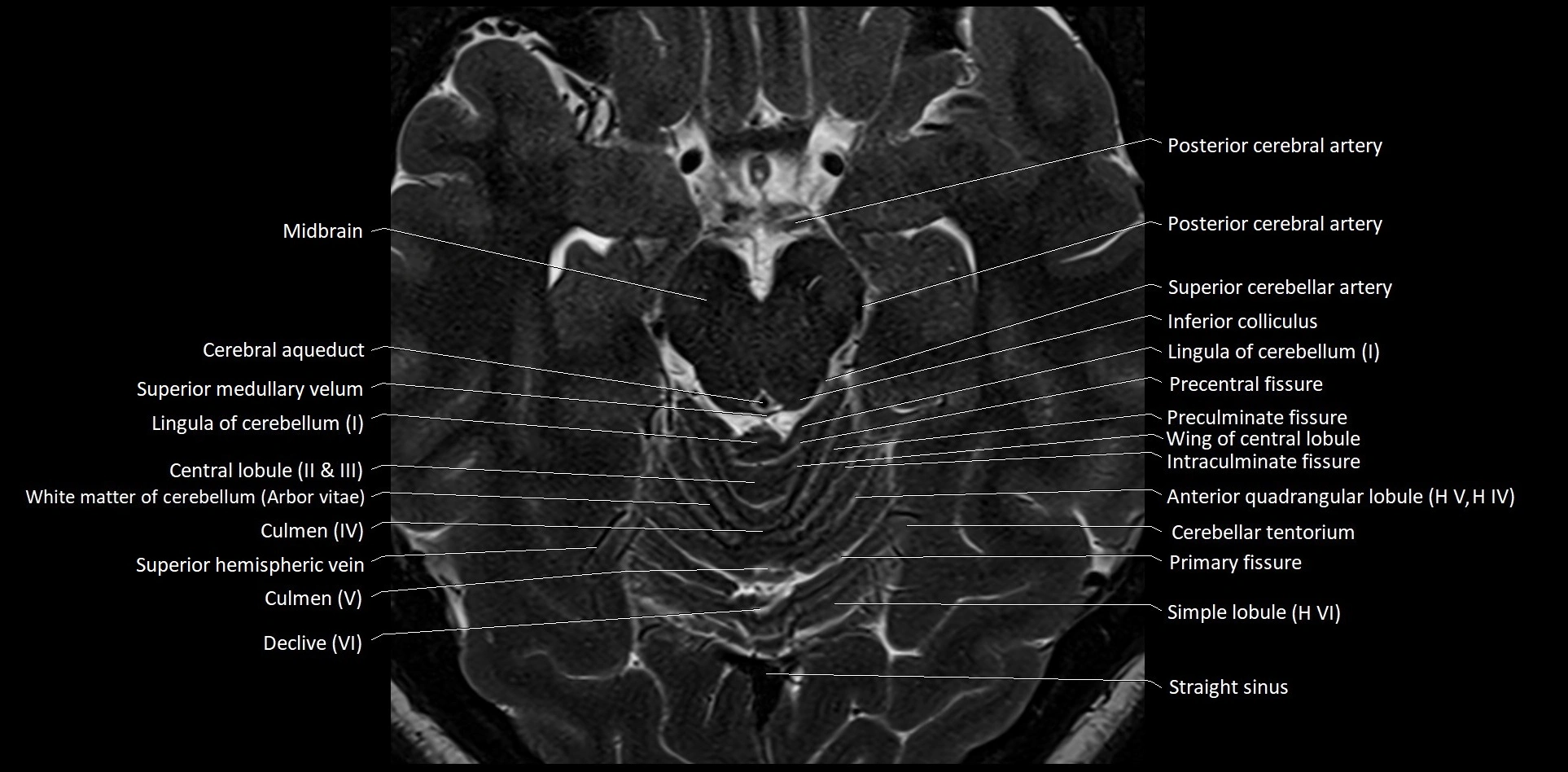 MRI Cerebellar anatomy High-resolution labelled 3T MRI image 23.webp